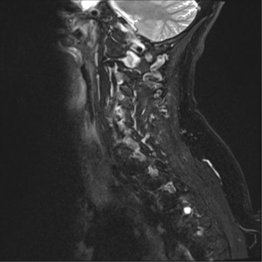 File:Chordoma (C4 vertebra) (Radiopaedia 47561-52189 Sagittal T2 fat sat 2).png