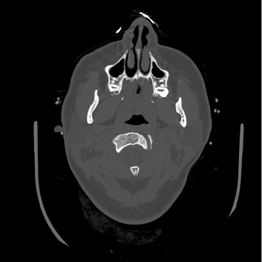 Choroid plexus papilloma extending into the cerebellopontine angle cistern (Radiopaedia 85941-101833 Axial bone window 6).png