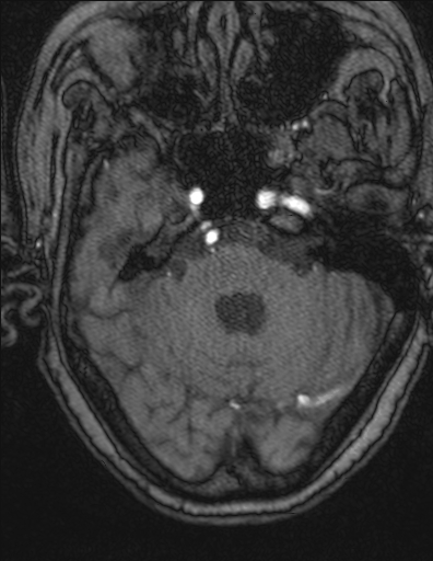 Choroid plexus xanthogranuloma - unilateral (Radiopaedia 85632-101393 Axial TOF 2).jpg