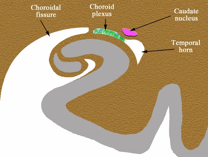 File:Choroidal fissure (diagram) (Radiopaedia 59364-97485 Coronal plane 1).jpg