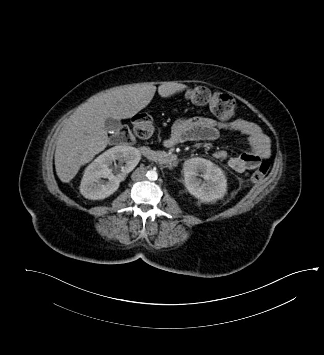 Chromophobe renal cell carcinoma (Radiopaedia 84239-99519 B 61).jpg