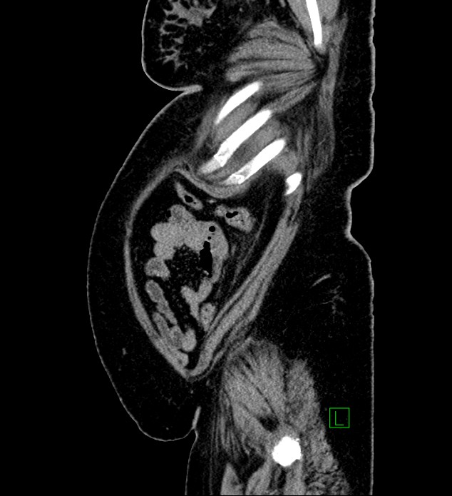 Chromophobe renal cell carcinoma (Radiopaedia 84239-99519 G 17).jpg