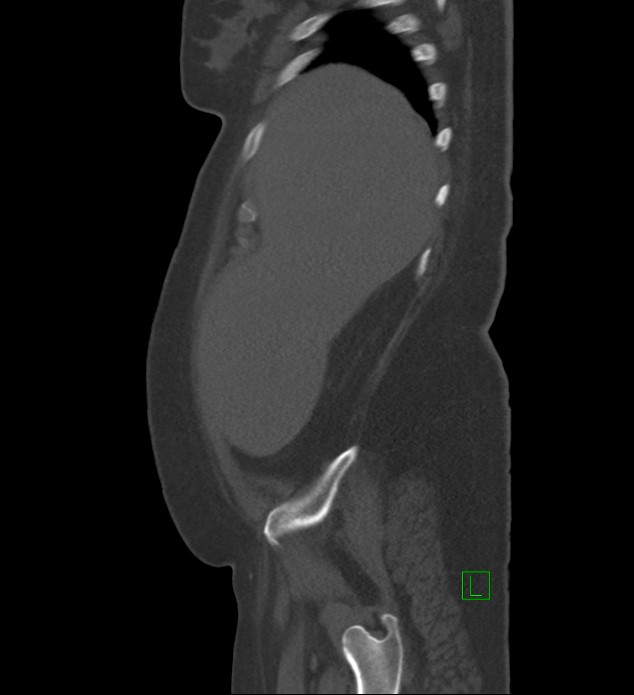 Chromophobe renal cell carcinoma (Radiopaedia 84239-99519 Sagittal bone window 92).jpg