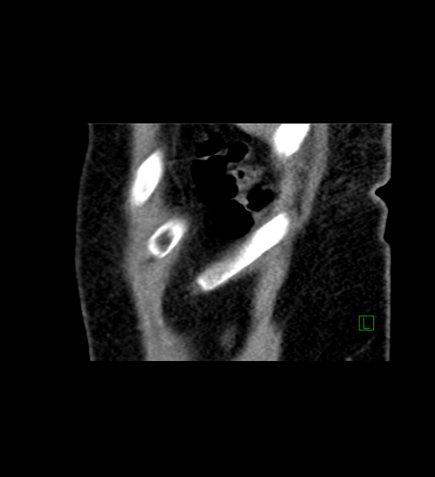 Chromophobe renal cell carcinoma (Radiopaedia 84290-99582 D 5).jpg