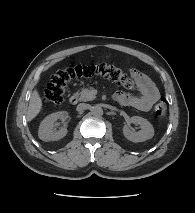 Chromophobe renal cell carcinoma (Radiopaedia 86879-103083 Axial non-contrast 36).jpg
