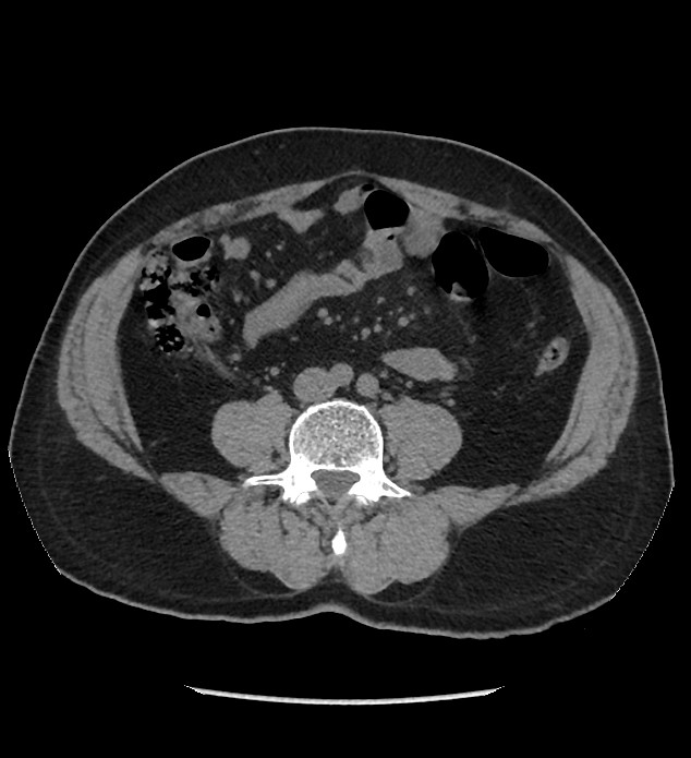 Chromophobe renal cell carcinoma (Radiopaedia 86879-103083 Axial non-contrast 69).jpg