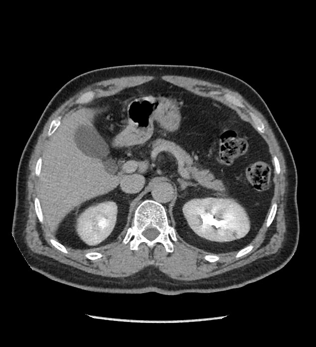 Chromophobe renal cell carcinoma (Radiopaedia 86879-103083 D 39).jpg