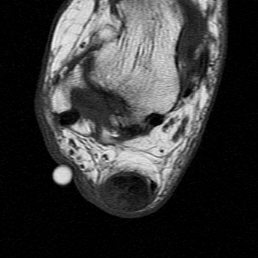 File:Chronic Achilles tendon rupture (Radiopaedia 15262-15100 Axial T1 17).jpg