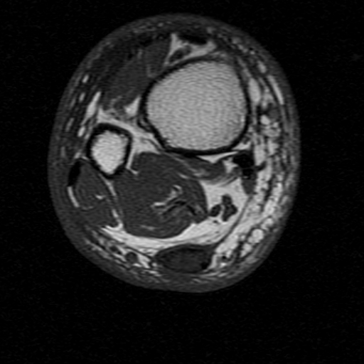 File:Chronic Achilles tendon rupture (Radiopaedia 15262-15100 Axial T1 3).jpg