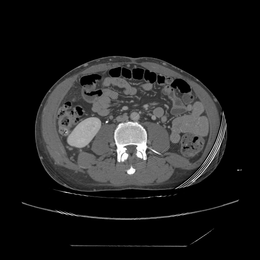 File:Chronic IVC thrombosis and resultant IVC filter malposition (Radiopaedia 81158-94800 A 124).jpg