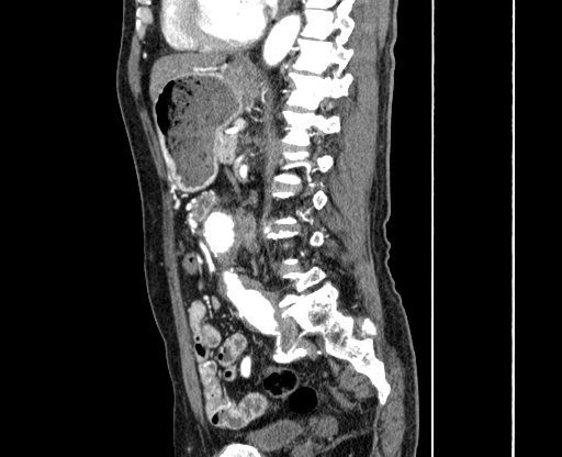 Chronic contained rupture of abdominal aortic aneurysm with extensive erosion of the vertebral bodies (Radiopaedia 55450-61901 B 44).jpg