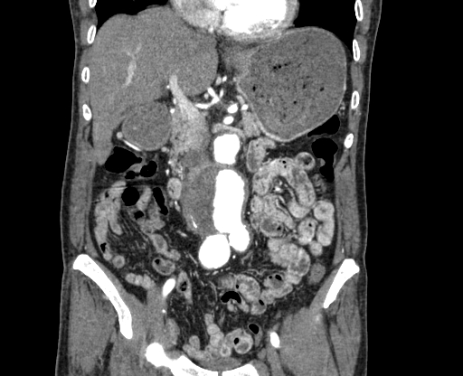 File:Chronic contained rupture of abdominal aortic aneurysm with extensive erosion of the vertebral bodies (Radiopaedia 55450-61901 D 25).jpg
