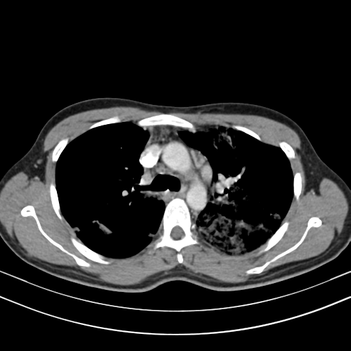 Chronic eosinophilic pneumonia (Radiopaedia 39331-41587 Axial C+ delayed 43).png