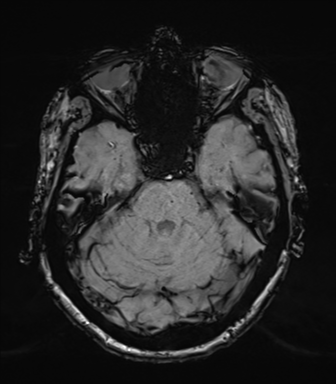 Chronic hypertensive encephalopathy (Radiopaedia 39993-42482 Axial SWI 26).png