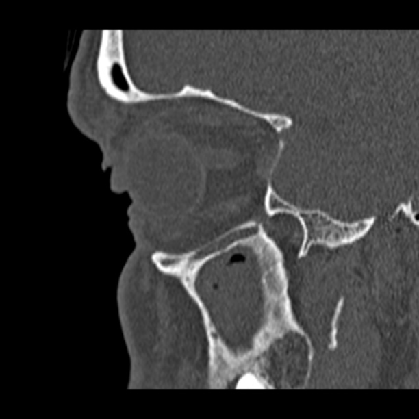 Chronic maxillary sinusitis (Radiopaedia 27879-28116 Sagittal bone window 9).jpg