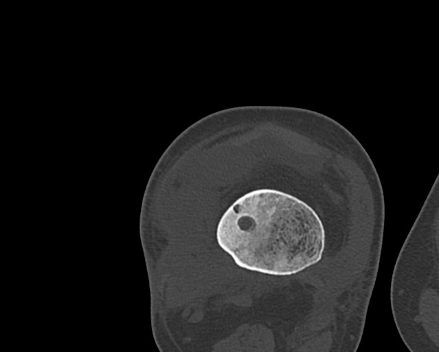 File:Chronic ostemyelitis of the femur with long sinus tract (Radiopaedia 74947-85982 Axial bone window 191).jpg