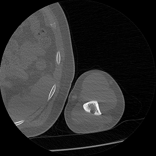 Chronic osteomyelitis (Radiopaedia 67597-76998 Axial bone window 56).jpg