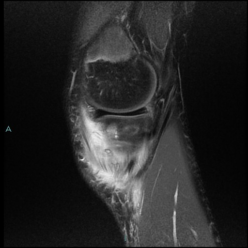 File:Chronic osteomyelitis (with Brodie abscess) (Radiopaedia 76405-88112 Sagittal PD fat sat 4).jpg