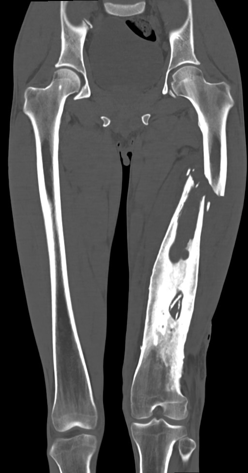 Chronic osteomyelitis (with sequestrum) (Radiopaedia 74813-85822 Coronal non-contrast 28).jpg