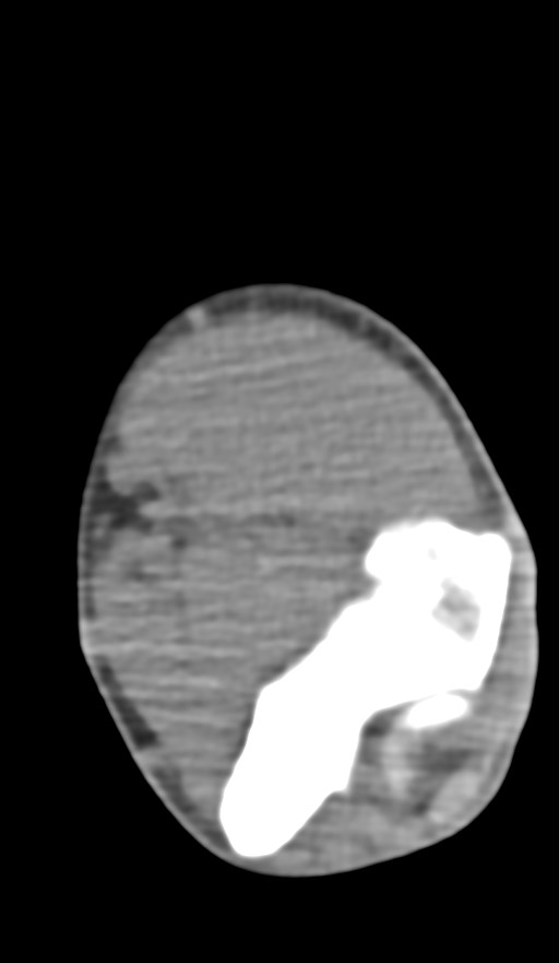 Chronic osteomyelitis of the distal humerus (Radiopaedia 78351-90971 Axial non-contrast 91).jpg