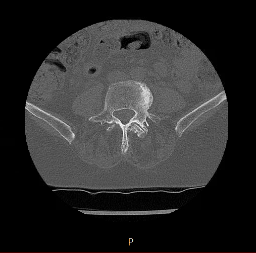 Chronic spinal hematoma with cauda equina syndrome (Radiopaedia 75745-88197 Axial bone window 53).png