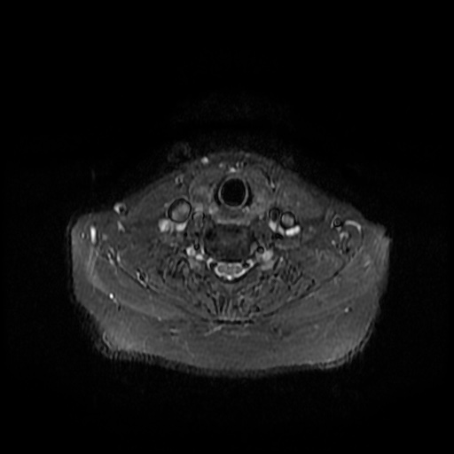 File:Chronic submandibular sialadenitis (Radiopaedia 61852-69885 Axial STIR 22).jpg