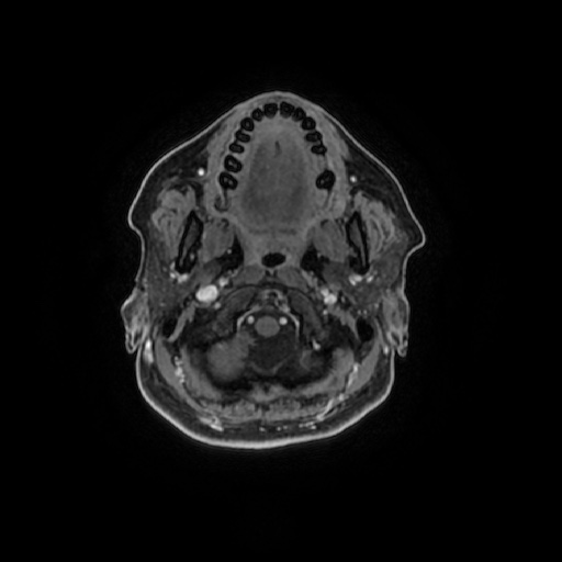 Chronic submandibular sialadenitis (Radiopaedia 61852-69885 Axial T1 C+ fat sat 94).jpg
