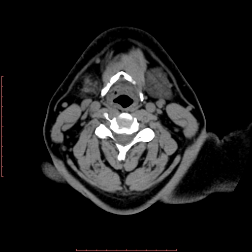 Chronic submandibular sialolithiasis (Radiopaedia 69817-79814 Axial non-contrast 140).jpg