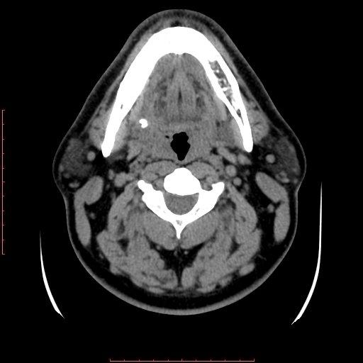 Chronic submandibular sialolithiasis (Radiopaedia 69817-79814 Axial non-contrast 99).jpg