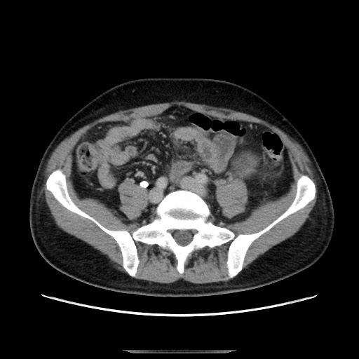 File:Chronic ureteropelvic junction obstruction (Radiopaedia 78365-90996 A 88).jpg