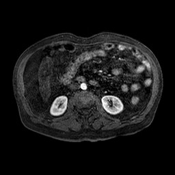Cirrhosis and hepatocellular carcinoma in the setting of hemochromatosis (Radiopaedia 75394-86594 Axial T1 C+ fat sat 98).jpg