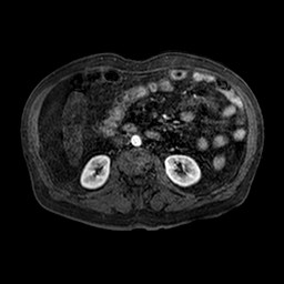 Cirrhosis and hepatocellular carcinoma in the setting of hemochromatosis (Radiopaedia 75394-86594 Axial T1 C+ fat sat 99).jpg