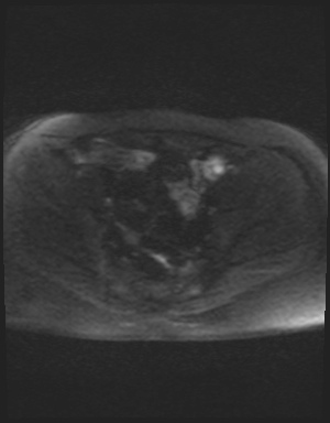 File:Class II Mullerian duct anomaly- unicornuate uterus with rudimentary horn and non-communicating cavity (Radiopaedia 39441-41755 Axial DWI 43).jpg