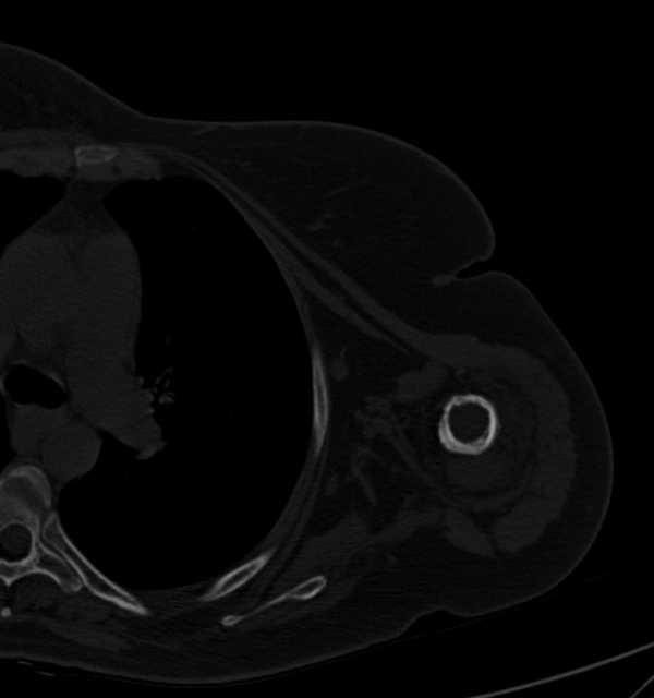 Clear cell chondrosarcoma - humerus (Radiopaedia 63104-71612 Axial bone window 69).jpg
