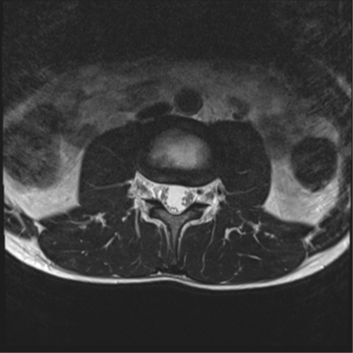 File:Clear cell meningoma - lumbar spine (Radiopaedia 60116-67690 Axial T2 27).png