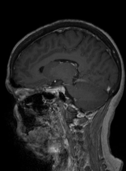 Clival meningioma (Radiopaedia 53278-59248 Sagittal T1 C+ 282).jpg