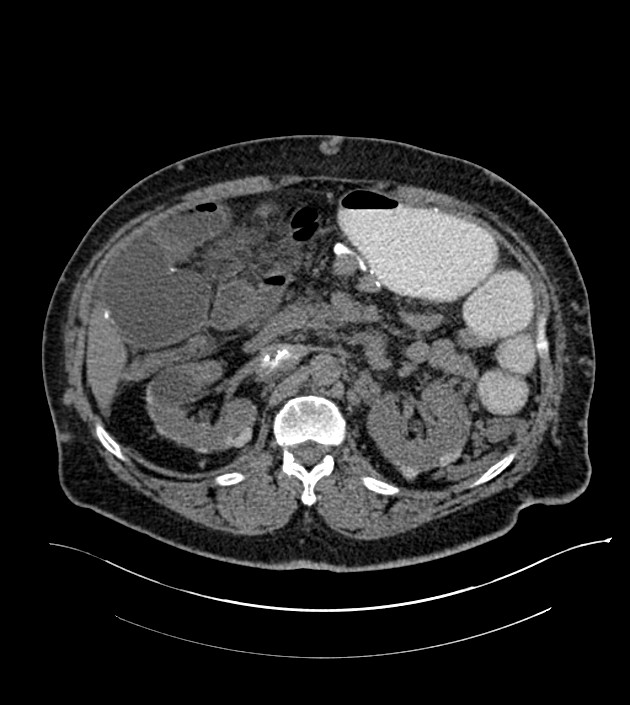 Closed-loop small bowel obstruction-internal hernia (Radiopaedia 78439-91096 Axial non-contrast 58).jpg