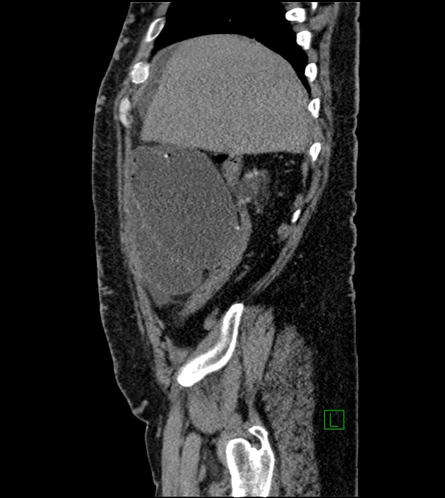 Closed-loop small bowel obstruction-internal hernia (Radiopaedia 78439-91096 C 116).jpg