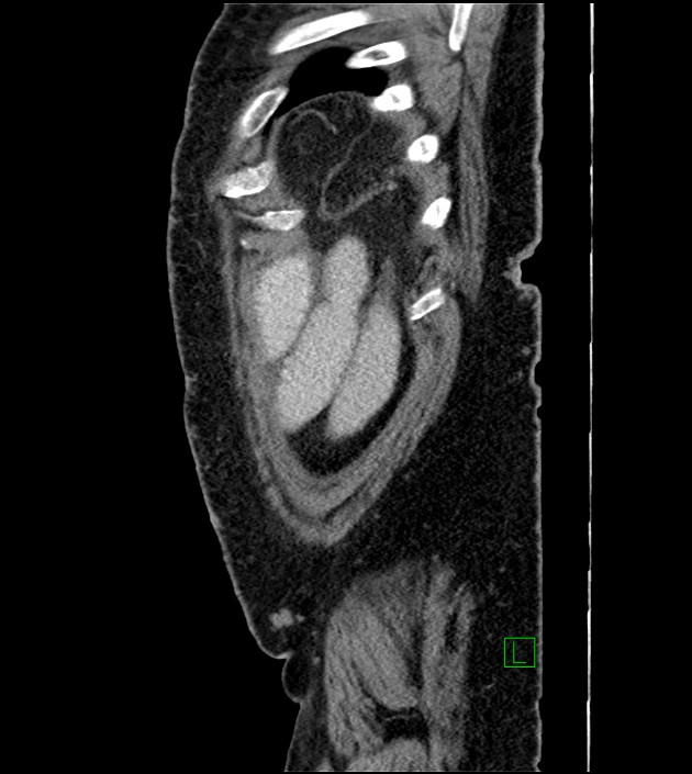 Closed-loop small bowel obstruction-internal hernia (Radiopaedia 78439-91096 C 22).jpg
