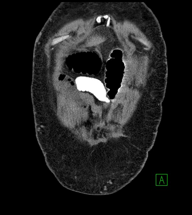 Closed-loop small bowel obstruction-internal hernia (Radiopaedia 78439-91096 Coronal non-contrast 19).jpg