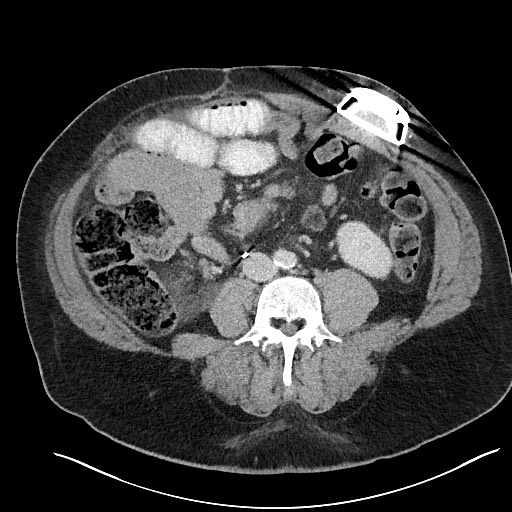 File:Closed loop obstruction - internal hernia into nephrectomy bed (Radiopaedia 59867-67320 A 84).jpg