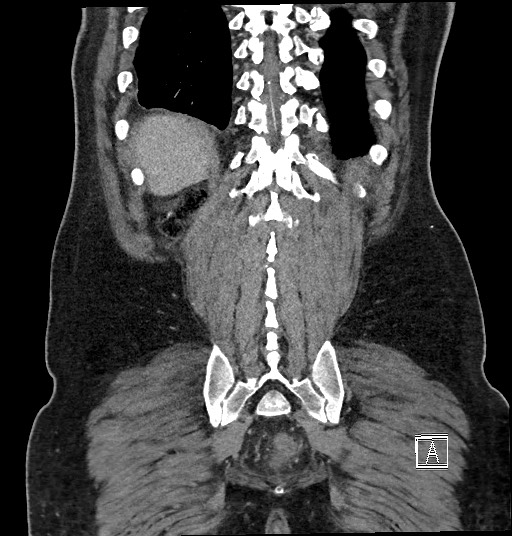 File:Closed loop obstruction - internal hernia into nephrectomy bed (Radiopaedia 59867-67320 B 121).jpg