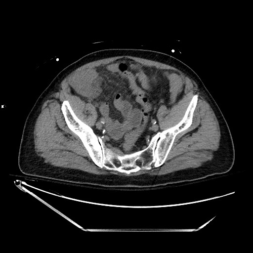 File:Closed loop obstruction due to adhesive band, resulting in small bowel ischemia and resection (Radiopaedia 83835-99023 Axial non-contrast 123).jpg