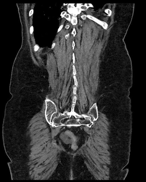 Closed loop small bowel obstruction - adhesions (Radiopaedia 59269-66611 B 108).jpg