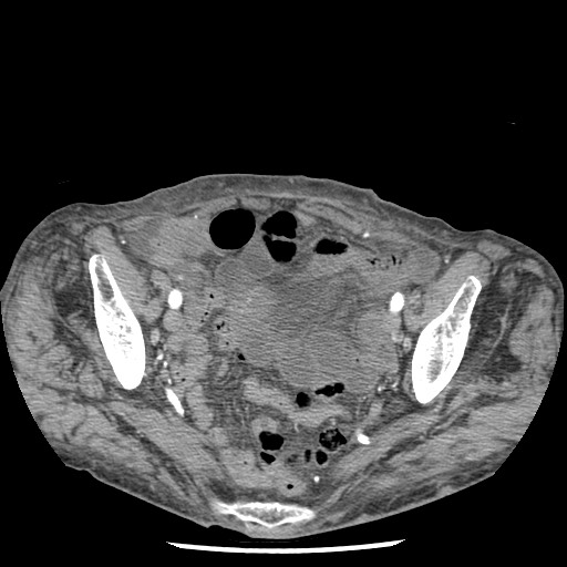 File:Closed loop small bowel obstruction - adhesions and infarct (Radiopaedia 85125-100678 A 165).jpg