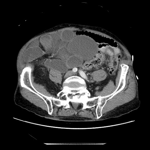 Closed loop small bowel obstruction - adhesive disease and hemorrhagic ischemia (Radiopaedia 86831-102990 A 129).jpg