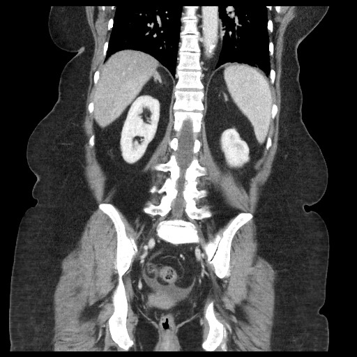 Closed loop small bowel obstruction - internal hernia (Radiopaedia 65402-74450 B 78).jpg