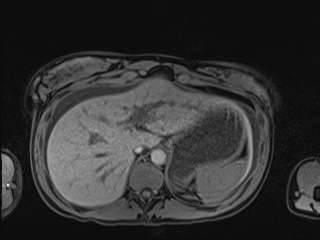 Closed loop small bowel obstruction in pregnancy (MRI) (Radiopaedia 87637-104031 Axial T1 fat sat 25).jpg