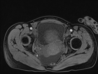 Closed loop small bowel obstruction in pregnancy (MRI) (Radiopaedia 87637-104031 G 15).jpg