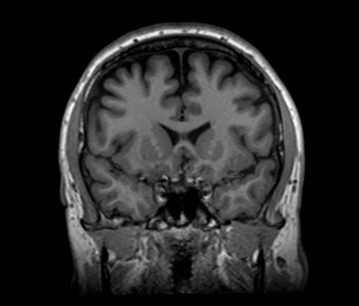 File:Cochlear incomplete partition type III associated with hypothalamic hamartoma (Radiopaedia 88756-105498 Coronal T1 41).jpg